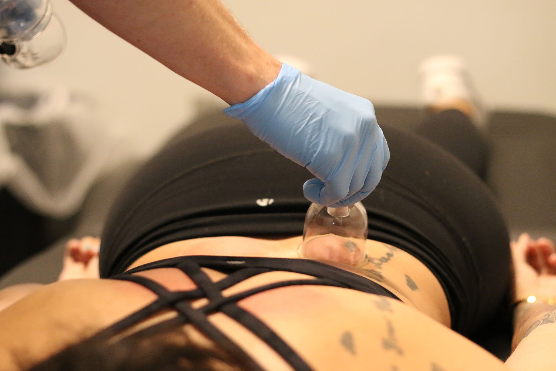 Everything You Need to Know About Cupping